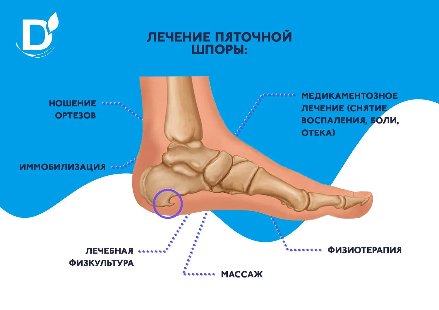 Что нужно знать про пяточные шпоры?
