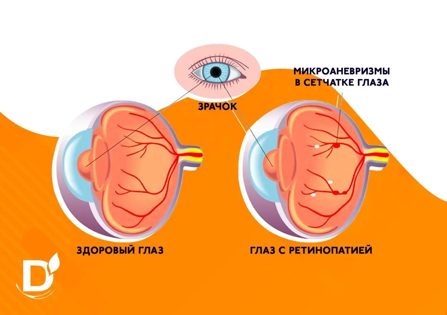 Диабетическая ретинопатия: лечение при сахарном диабете в Оксфорд Медикал Киев