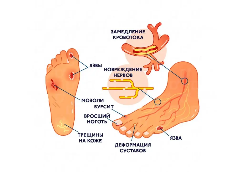 Диабетическая стопа – симптомы и лечение
